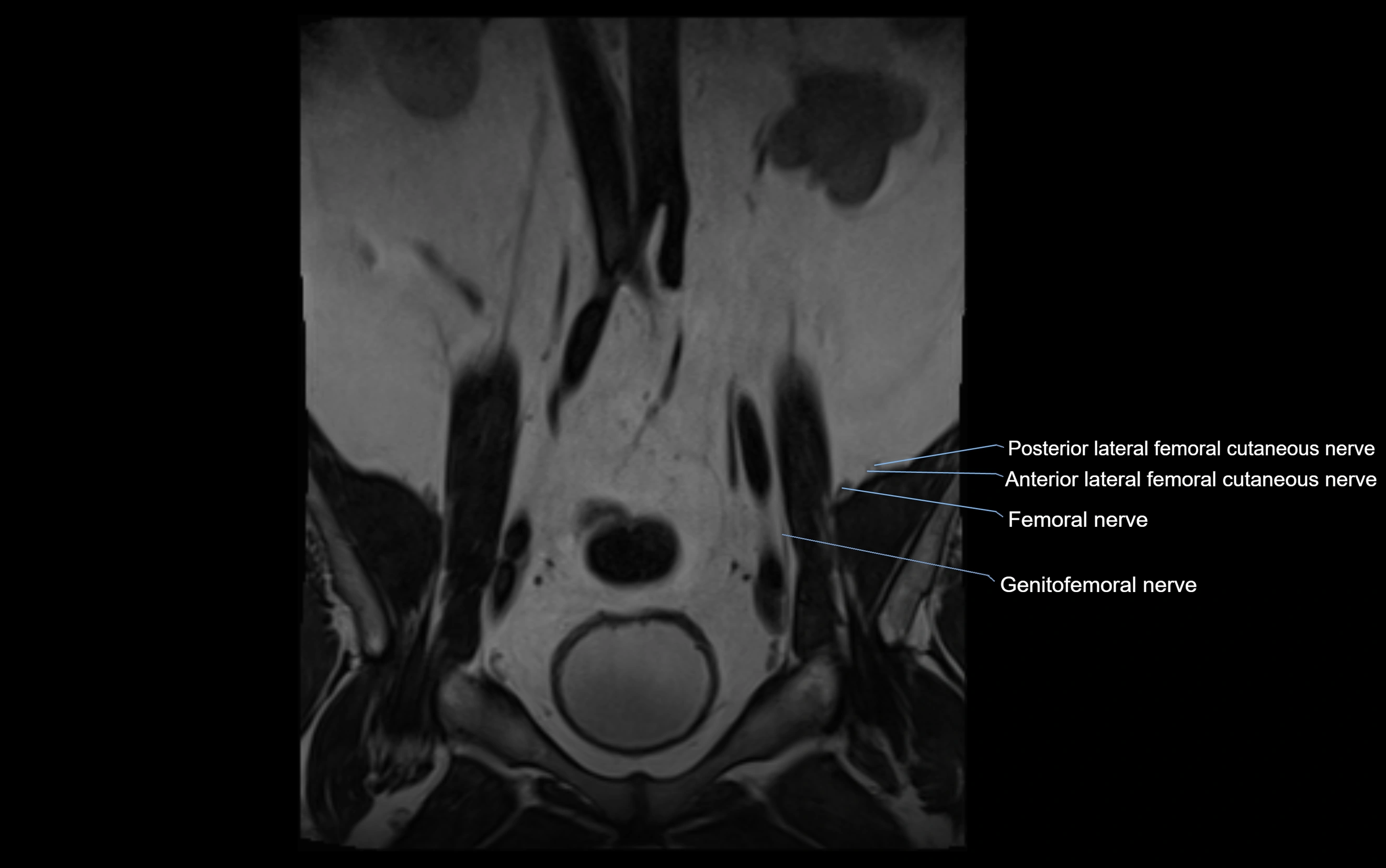 MR lumbosacral plexus cross sectional anatomy 3T  radiology  image-img-09001-00003.webp